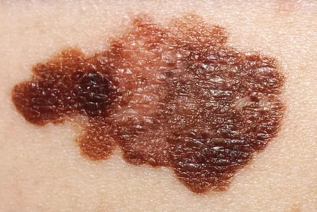 Stock image shows what melanoma can look like.